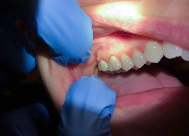 Best Emergency Root Canal Therapy in Roselle, IL