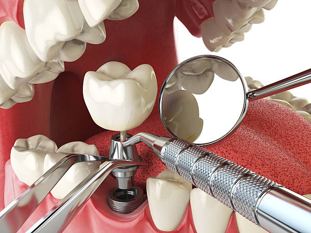 Best Lost Filling or Crown Replacement in Roselle, IL